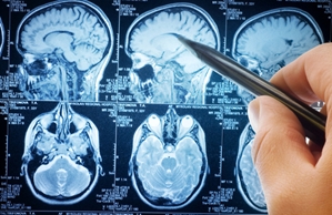 Stroke symptoms could damage the brain