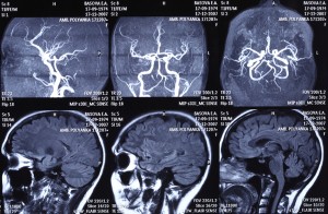 Different people suffer unique concussion symptoms